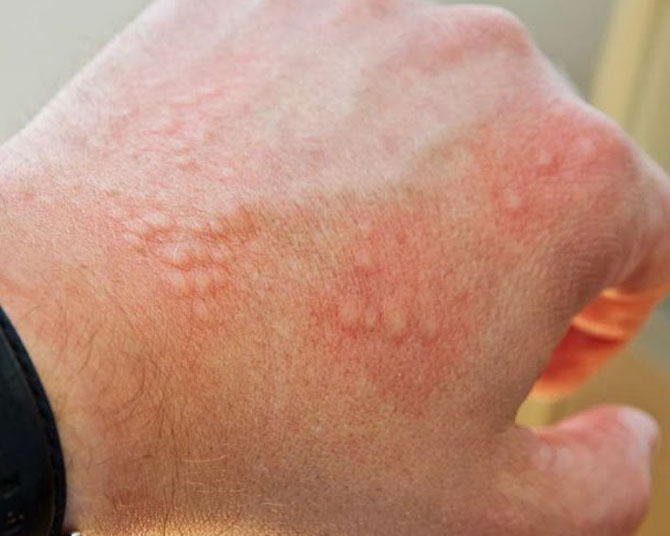 allergy