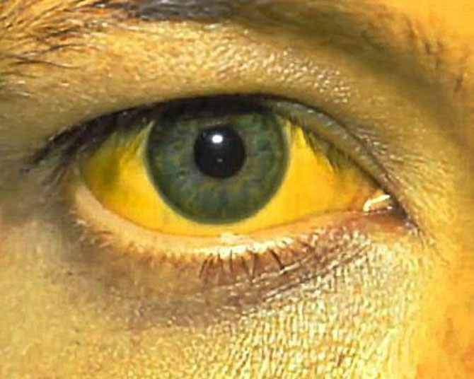 jaundice  Treatment