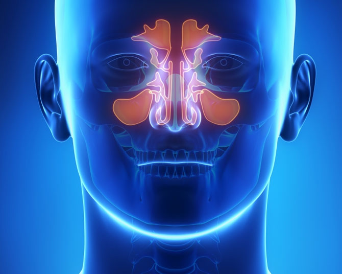 Sinusitis