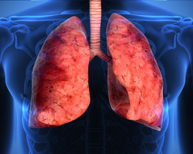 Asthma