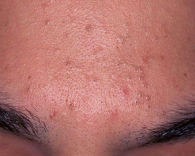 Acne Treatment