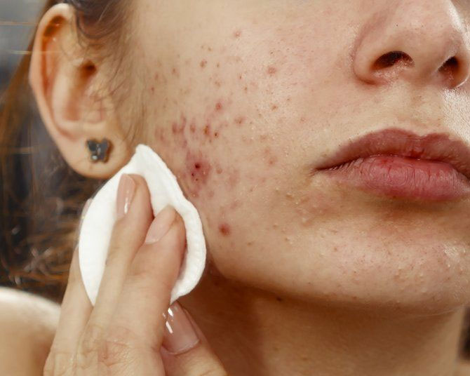 pimple Treatment