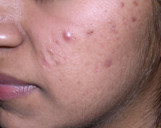 acne  Treatment